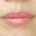 ヒアルロン酸注入（唇） アネシス美容クリニック BEFORE サムネイル用