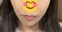 ヒアルロン酸注入（唇） ルラ美容クリニック 岐阜院 BEFORE サムネイル用