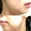 ボトックス（エラ・小顔） 日本ウェルネス再生クリニック BEFORE サムネイル用