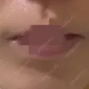 ボトックス（口角） 美容皮膚科エルムクリニック 岡山院 BEFORE サムネイル用