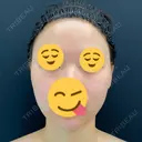 額を丸く / 下まぶたの脂肪取り / 脂肪注入（額） / 脂肪注入（目の下） イテウォンビューティークリニック 名古屋栄院 BEFORE サムネイル用
