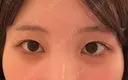 二重埋没 湘南美容クリニック 池袋東口院 BEFORE サムネイル用