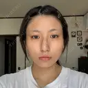 ボトックス（エラ・小顔） / ボトックス（肩） DMTC美容皮膚科 大宮院 BEFORE サムネイル用