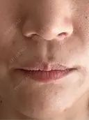 人中短縮 / 小鼻縮小（非切開） 湘南美容クリニック 仙台院 BEFORE サムネイル用