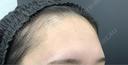 脂肪注入（額） eクリニック 富山院 BEFORE サムネイル用