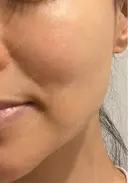 RF（高周波）たるみ治療 渋谷美容外科クリニック 渋谷院 BEFORE サムネイル用
