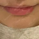 ヒアルロン酸注入（唇） / ボトックス（口角） ルラ美容クリニック 岐阜院 BEFORE サムネイル用