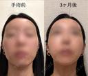 骨切り（あご） / 骨削り（エラ） / 骨削り（頬） セギム美容整形外科 BEFORE サムネイル用