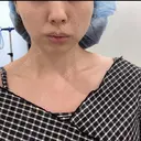 糸リフト Stand by Beauty Clinic BEFORE サムネイル用