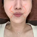 ショッピングリフト APスキンクリニック銀座 BEFORE サムネイル用