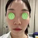 エレクトロポレーション / ピコレーザートーニング（美白・肝斑） 東京美容クリニック 表参道本院 BEFORE サムネイル用