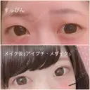 二重切開 / 上まぶたたるみ取り / 上まぶたの脂肪取り 銀座高須クリニック BEFORE サムネイル用