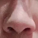 小鼻縮小（切開） 東京ヒルズクリニック 新宿院 BEFORE サムネイル用