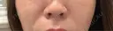 ヒアルロン酸注入（鼻翼基部） 大美会クリニック 梅田院 BEFORE サムネイル用
