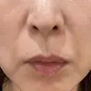 ショッピングリフト BAO CLINIC 梅田院 BEFORE サムネイル用