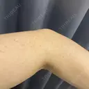 白玉点滴・注射 TCB東京中央美容外科 浜松院 BEFORE サムネイル用