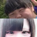 二重埋没 R Beauty CLINIC 銀座院 BEFORE サムネイル用