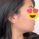 糸リフト / 脂肪吸引（顔） THE FIRST CLINIC 多摩センター院 BEFORE サムネイル用