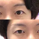 二重埋没 けやき美容クリニック 沼津院 BEFORE サムネイル用