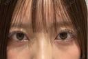 ヒアルロン酸注入（涙袋） eクリニック 横浜みなとみらい院 BEFORE サムネイル用
