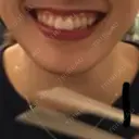 ガミースマイル手術 有楽町美容外科クリニック BEFORE サムネイル用