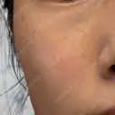 ルメッカ 大美会クリニック 京都烏丸院 BEFORE サムネイル用