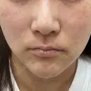 ピーリング（ニキビ・毛穴） 渋谷美容外科クリニック 横浜院 BEFORE サムネイル用