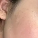 ルメッカ 栄美容クリニック 栄院 BEFORE サムネイル用