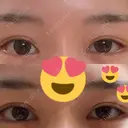 ボトックス（タレ目） フィラークリニック 新宿院 BEFORE サムネイル用