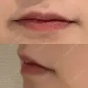 ヒアルロン酸注入（唇） / ボトックス（口角） ルラ美容クリニック 大阪心斎橋院 BEFORE サムネイル用