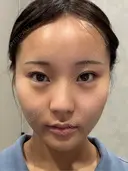 糸リフト / 脂肪吸引注射（顔） 札幌美容外科ネビュラクリニック BEFORE サムネイル用
