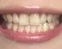 ホワイトニング 銀座本院 歯と美容のクリニック BEFORE サムネイル用
