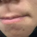 医療脱毛（顔） 新宿Ladies&Gentlemen美容クリニック BEFORE サムネイル用