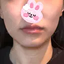 その他（輪郭） / RF（高周波）たるみ治療 Clinic K Blossom BEFORE サムネイル用