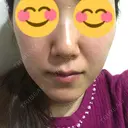 脂肪溶解注射（顔） / その他（肌） The-Clim産婦人科  BEFORE サムネイル用