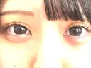 二重埋没 日本ウェルネス再生クリニック BEFORE サムネイル用