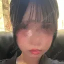 ボトックス（あご） / ヒアルロン酸注入（あご） / ボトックス（エラ・小顔） SUNMELIA SKIN CLINIC BEFORE サムネイル用