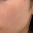 ルメッカ 東京美容外科 名古屋院 BEFORE サムネイル用