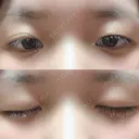 二重切開 / 上まぶたの脂肪取り 城本クリニック 長崎院 BEFORE サムネイル用