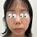 水光注射（ハリ・美肌） / マイクロボトックス DAILY SKIN CLINIC 心斎橋院 BEFORE サムネイル用