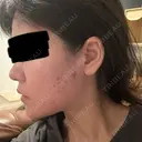 ボトックス（あご） / ボトックス（エラ・小顔） / ボトックス（口角） / ワキ汗治療（ボトックス） DMTC CLINIC 日本橋院 BEFORE サムネイル用