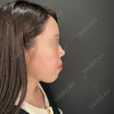 ボトックス（あご） / ヒアルロン酸注入（あご） / ボトックス（眉間） / ヒアルロン酸注入（鼻翼基部） HAAB×DREAM BEAUTY CLINIC 大阪梅田院 BEFORE サムネイル用