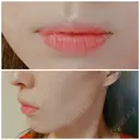 ガミースマイル手術 / ヒアルロン酸注入（唇） / ボトックス（口角） エートップ美容整形外科 BEFORE サムネイル用