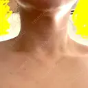 ボトックス（肩） 大美会クリニック 京都烏丸院 BEFORE サムネイル用