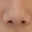 鼻尖形成（切開） / 軟骨移植 アネシス美容クリニック BEFORE サムネイル用