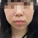 ボトックス（あご） / ヒアルロン酸注入（あご） / ヒアルロン酸注入（鼻翼基部） ルラ美容クリニック 大宮院 / ルラスキンクリニック 大宮院 BEFORE サムネイル用