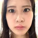 ヒアルロン酸注入（涙袋） 共立美容外科 梅田院 BEFORE サムネイル用