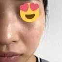 ピーリング（ハリ・ツヤ） / ルメッカ PureMe Skin Clinic（ピュアミースキンクリニック麻布） BEFORE サムネイル用
