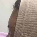 額を丸く エートップ美容整形外科 BEFORE サムネイル用
