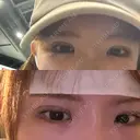二重埋没 / クマ治療 / 上まぶたの脂肪取り / ヒアルロン酸注入（鼻） / ボトックス（エラ・小顔） / ヒアルロン酸注入（目の下） TCB東京中央美容外科 広島院 BEFORE サムネイル用